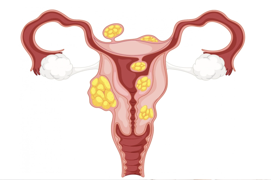 Genital Siğil Belirtileri