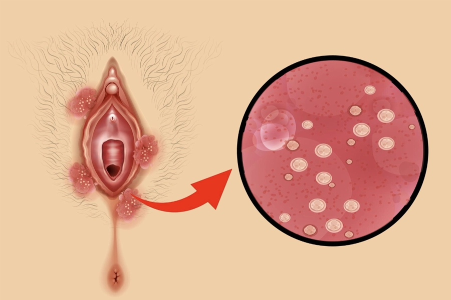 Genital Siğil Nedir?