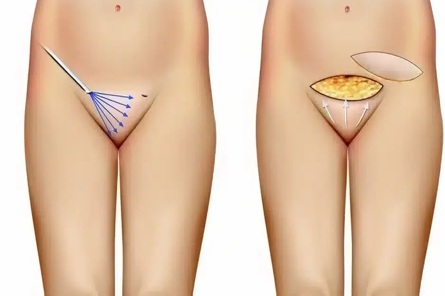 Vulva Bölge Yağ Enjeksiyonu